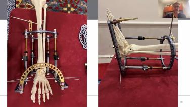 foot and ankle prop from the video series Delta Max™ Webinar with Geoffrey Marecek, MD