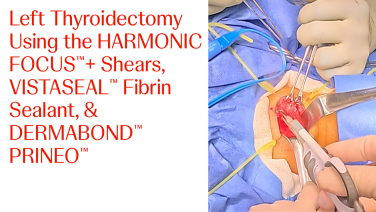 An image of "Left Thyroidectomy Using the HARMONIC FOCUS™+ Shears"