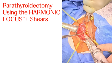 An Image From "Parathyroidectomy Using the HARMONIC FOCUS™+ Shears"