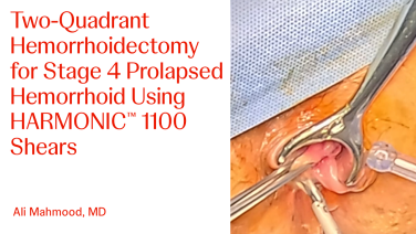 An Image From "Two-Quadrant Hemorrhoidectomy for Stage 4 Prolapsed Hemorrhoid Using HARMONIC™ 1100 Shears with Ali Mahmood, MD"