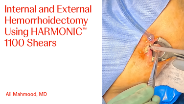 An Image From "Internal and External Hemorrhoidectomy Using HARMONIC™ 1100 Shears with Ali Mahmood, MD"