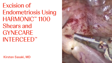 An Image From "Excision of Endometriosis Using HARMONIC™ 1100 Shears and GYNECARE INTERCEED™ with Kirsten Sasaki, MD"
