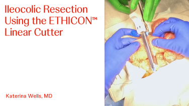 An Image From "Ileocolic Resection Using the ETHICON™ Linear Cutter with Katerina Wells, MD"