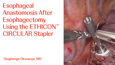 Thmbnail image of Esophageal Anastomosis After Esophagectomy Using the ETHICON™ CIRCULAR Stapler with Olugbenga Okusanya, MD