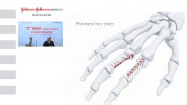 An image from the "The Variable Angle Hand Locking System Presented by Douglas Campbell, MD" video on the JnJInstitute.com website.