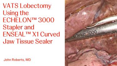 An Image From "Watch this video to learn more as Dr. Roberts performs a VATS procedure using the ECHELON™ 3000 stapler. This content is intended for Health Care Professionals in the United States. "