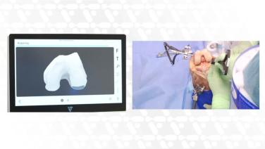 A header image of VELYSTM Robotic-Assisted Solution Total Knee Arthroplasty Procedure: Tibia First Approach