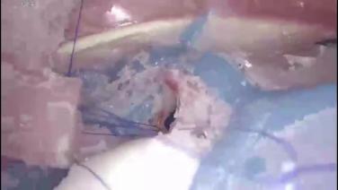 An Image From "EMEA Ethicon Stupnik Simulator VATS Sleeve Lobectomy"