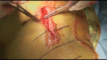 An Image From "Total Hip Arthroplasty Procedure Video with Ryan Nunley, MD"