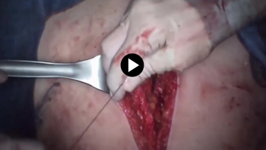 Total Abdominal Hysterectomy - Abdominal Wall Closure