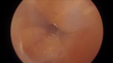 Laparoscopic Right Hemicolectomy - Initial Access