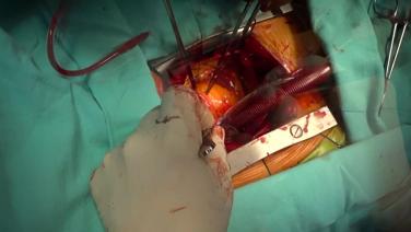 Aortic Valve Replacement (AVR) - Accessing The Aortic Valve 1/3