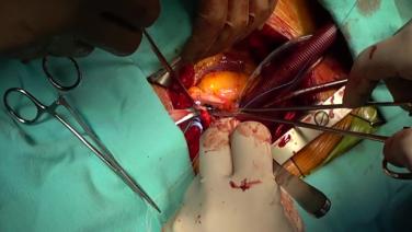 Aortic Valve Replacement (AVR) - Accessing The Aortic Valve 2/3