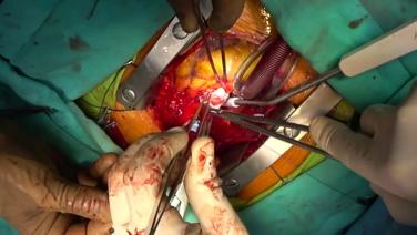 Aortic Valve Replacement (AVR) - Accessing The Aortic Valve 3/3
