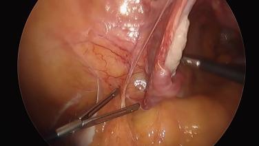 Total Laparoscopic Hysterectomy - Adhesiolysis