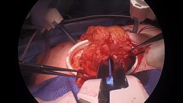 Laparoscopic Right Hemicolectomy - Anastomosis