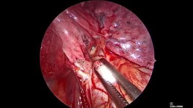 Thorascopic Lobectomy - Anterior Hilar Dissection