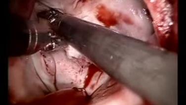 Mitral Valve Repair (MVR) - Inspection of Anterior Perforation