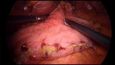 Laparoscopic Sleeve Gastrectomy - Insert Bougie
