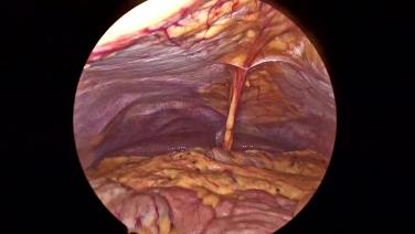 Laparoscopic Appendectomy - Closure