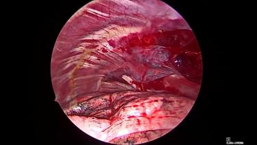 Thorascopic Lobectomy - Chest Tube Placement