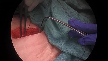 Laparoscopic Right Hemicolectomy - Closure