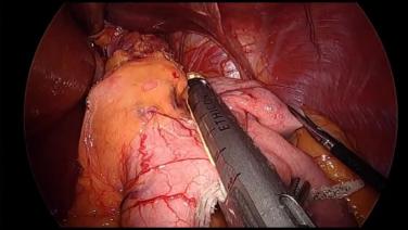 Laparoscopic Sleeve Gastrectomy - Create Sleeve