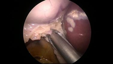 Laparoscopic Cholecystectomy - Identify & Ligate Cystic Artery