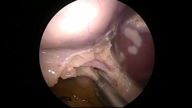 Laparoscopic Cholecystectomy - Identify & Ligate Cystic Duct