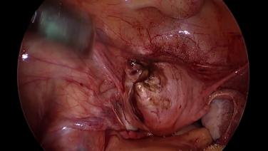 Laparoscopic Myomectomy - Closure Of The Defect