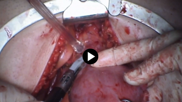 Total Abdominal Hysterectomy - Divide the Broad Ligament