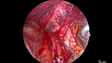 Thorascopic Lobectomy - Encircle the Pulmonary Vein