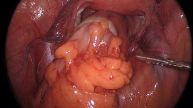 Laparoscopic Low Anterior Resection - End to End Anastomosis