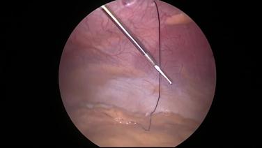 Laparoscopic Cholecystectomy - Close Fascia