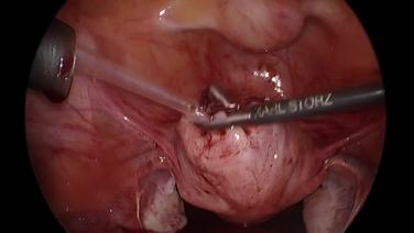 Laparoscopic Myomectomy - Topical Hemostat on Fibroid