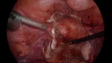 Laparoscopic Myomectomy - Topical Hemostat on Suture Closure Site