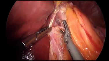 Laparoscopic Sleeve Gastrectomy - Repair Hiatal Hernia