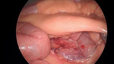 Laparoscopic Right Hemicolectomy - Ligate & Divide Ileocolic Artery & Vein