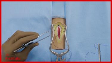 Abdominal Closure