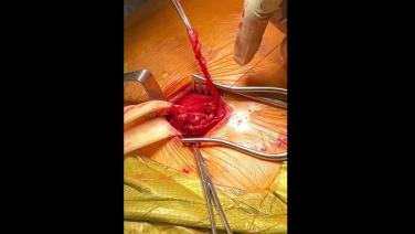 Inguinal Hernia Repair Open