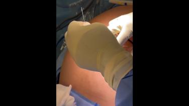 Ventral Hernia Repair - Small Umbilical Hernia without mesh