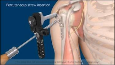 Image from Proximal Humerus Screw Insertion Animation 