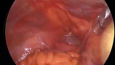 Laparoscopic Low Anterior Resection - Insert Trocars