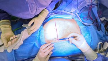 Right Hepatectomy - Incision