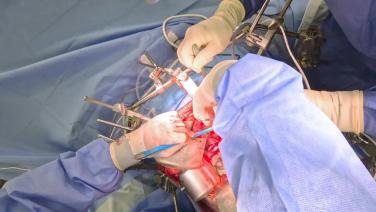 Right Hepatectomy - Inflow Control