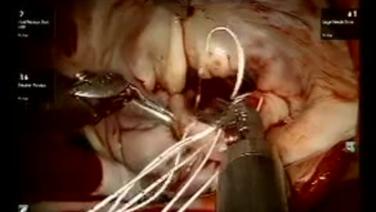 Mitral Valve Repair (MVR) - Insertion of Loops onto Leaflets