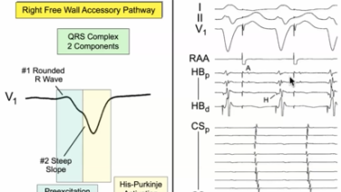 Warren Jackman - ECG Summit