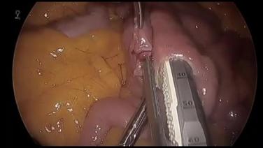 Laparoscopic Roux-en-Y Gastric Bypass - Create Jejunostomy