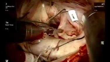 Mitral Valve Repair (MVR) - Knot Tying of Loops