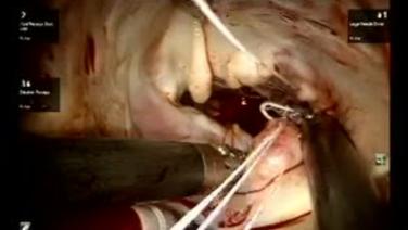 Mitral Valve Repair (MVR) - Valvuloplasty